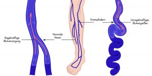 Arm blaue adern am Venenthrombose: Symptome